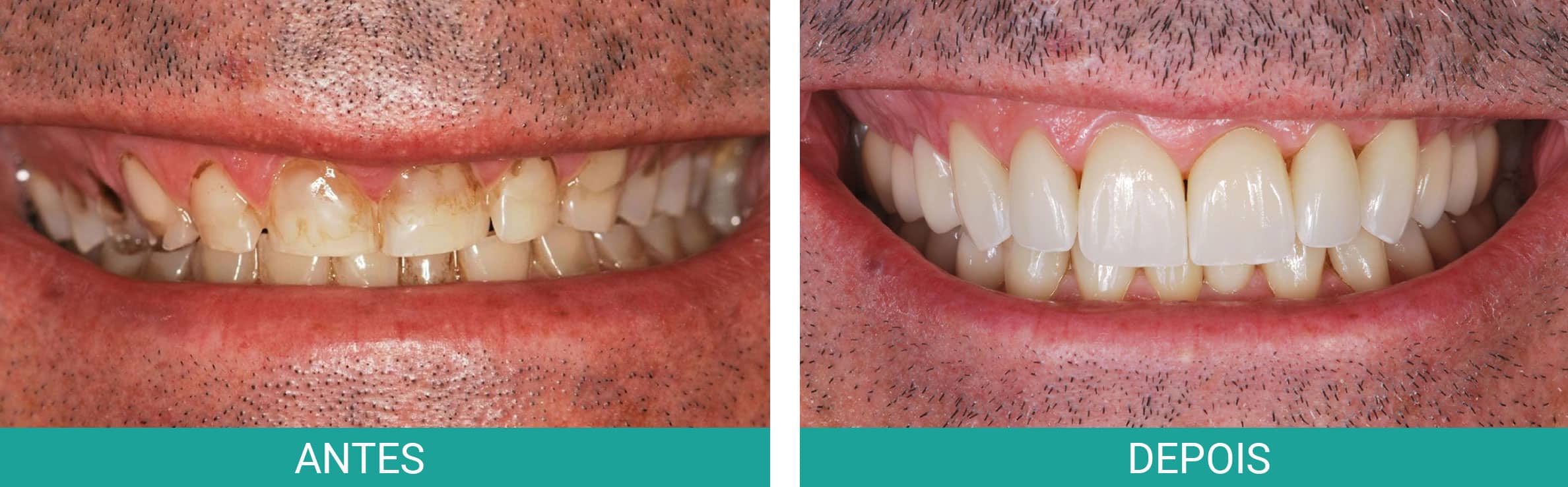 antes-depois-coroa