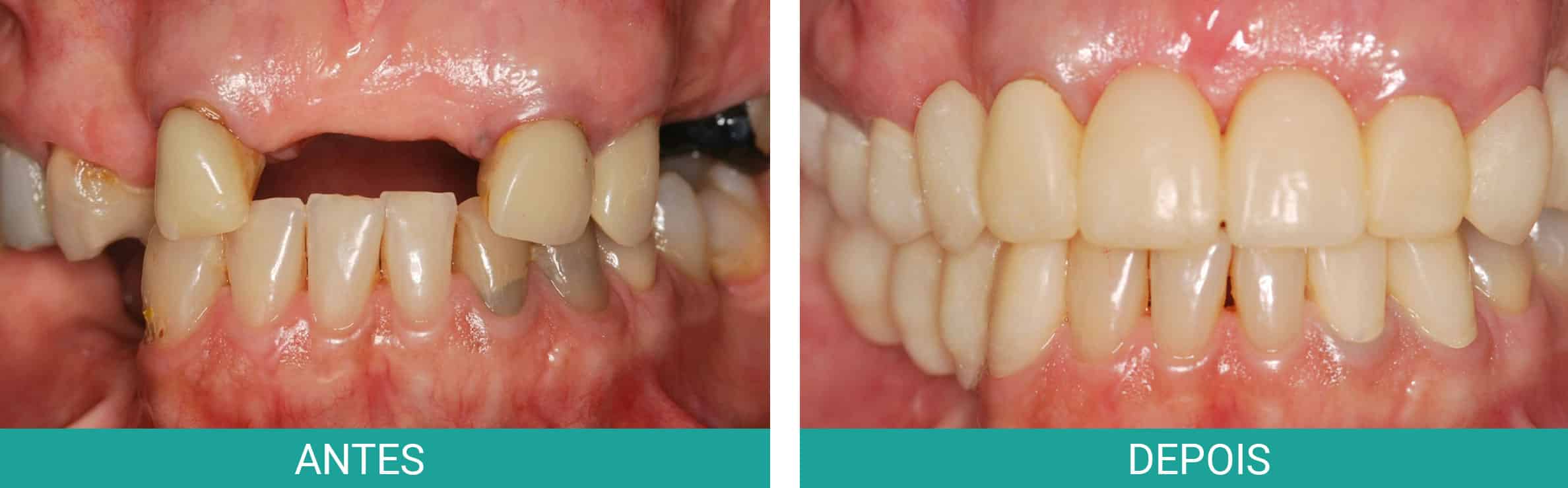 antes-depois-implante