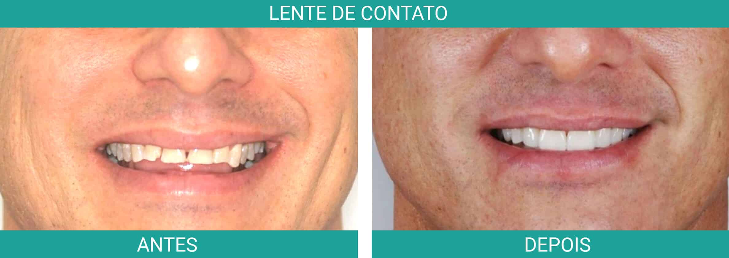 antes-depois-lente-contato
